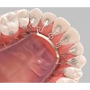 tooth extraction - Dental Villa