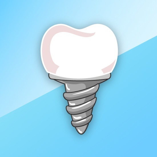 dental implant