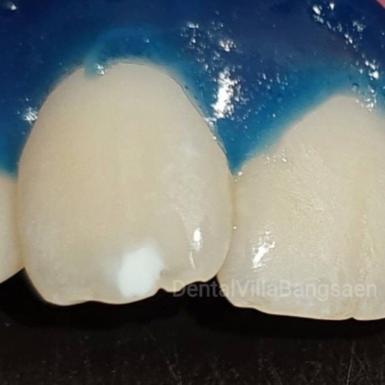 Laser Dentistry  เลเซอร์ทางทันตกรรม เลเซอร์แก้ปัญหายิ้มเห็นเหงือก - Dental Villa